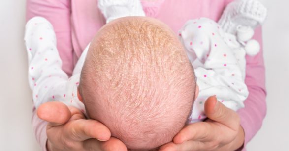 چه زمانی برای درمان شوره سر نوزاد حتما باید به پزشک مراجعه کنید ؟
