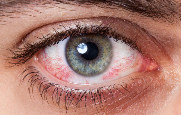 خشکی چشم: علت‌ها، علائم، درمان و پیشگیری